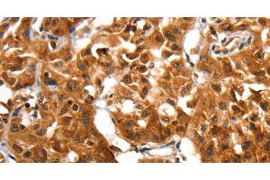 Immunohistochemistry of paraffin-embedded Human lung cancer using ADAP1 Polyclonal Antibody at dilution of 1:60 (ADAP1 Antikörper)