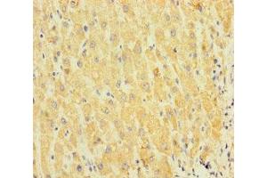Immunohistochemistry of paraffin-embedded human liver cancer using ABIN7170610 at dilution of 1:100 (SPIN4 Antikörper  (AA 1-249))