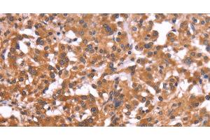 Immunohistochemistry of paraffin-embedded Human thyroid cancer tissue using CRISP3 Polyclonal Antibody at dilution 1:50 (CRISP3 Antikörper)