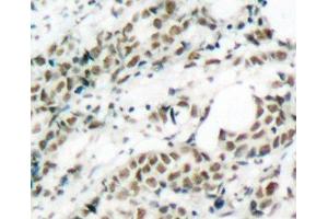 Immunohistochemistry of paraffin-embedded Human breast carcinoma tissue, using Phospho-FOXO4(S197) Polyclonal Antibody (FOXO4 Antikörper  (pSer197))