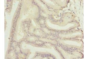 Immunohistochemistry of paraffin-embedded human prostate cancer using ABIN7161983 at dilution of 1:100 (Nucleolar Protein 6 Antikörper  (AA 951-1146))