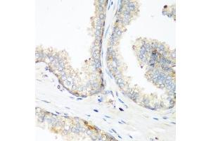 Immunohistochemistry of paraffin-embedded human prostate using NEDD4 antibody (ABIN1681009, ABIN3015207, ABIN3015208 and ABIN6213883) at dilution of 1:200 (40x lens).
