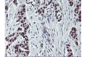 Immunohistochemical staining of paraffin-embedded Carcinoma of Human lung tissue using anti-ANKRD53 mouse monoclonal antibody. (ANKRD53 Antikörper  (AA 1-300))