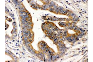 Anti-Rab5 Picoband antibody,IHC(P) IHC(P): Human Intestinal Cancer Tissue (RAB5 Antikörper  (C-Term))