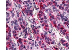Anti-GPR1 antibody IHC of human Breast, Carcinoma. (G Protein-Coupled Receptor 1 Antikörper  (C-Term))