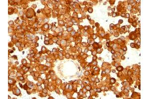 Formalin-fixed, paraffin-embedded human melanoma stained with CD63 Mouse Monoclonal Antibody (MX-49. (CD63 Antikörper)