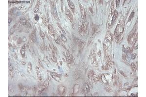 Immunohistochemical staining of paraffin-embedded Carcinoma of pancreas using anti-PDX1 (ABIN2452675) mouse monoclonal antibody. (PDX1 Antikörper)