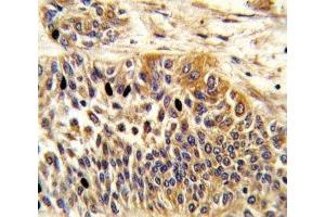 IHC analysis of FFPE human bladder carcinoma stained with WNT4 antibody (WNT4 Antikörper  (AA 211-239))