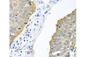 Immunohistochemistry of paraffin-embedded Human lung cancer using EIF4E Polyclonal Antibody at dilution of 1:100 (40x lens). (EIF4E Antikörper)