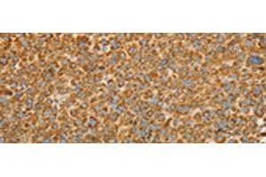Immunohistochemistry of paraffin-embedded Human liver cancer tissue using VDAC2 Polyclonal Antibody at dilution of 1:25(x200) (VDAC2 Antikörper)