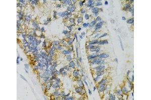 Immunohistochemistry of paraffin-embedded Human gastric cancer using SLC27A2 Polyclonal Antibody at dilution of 1:100 (40x lens). (SLC27A2 Antikörper)