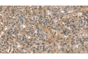 Immunohistochemistry of paraffin-embedded Human liver cancer using SSX2IP Polyclonal Antibody at dilution of 1:45