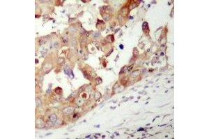 Immunohistochemical analysis of PAK1 staining in human prostate cancer formalin fixed paraffin embedded tissue section. (PAK1 Antikörper)