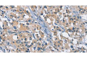 Immunohistochemistry of paraffin-embedded Human thyroid cancer tissue using GAS2 Polyclonal Antibody at dilution 1:50 (GAS2 Antikörper)