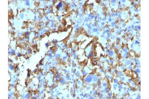 Formalin-fixed, paraffin-embedded human Histiocytoma stained with HLA-DR Monoclonal Antibody (HLA-DRB/1067). (HLA-DRB1 Antikörper)