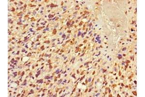 Immunohistochemistry of paraffin-embedded human glioma using ABIN7152681 at dilution of 1:100 (FRMD5 Antikörper  (AA 295-504))