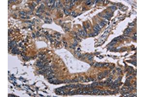 The image on the left is immunohistochemistry of paraffin-embedded Human colon cancer tissue using ABIN7128956(CLDND1 Antibody) at dilution 1/50, on the right is treated with fusion protein. (CLDND1 Antikörper)