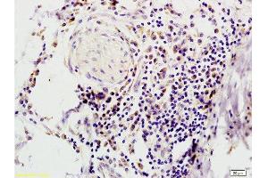 Formalin-fixed and paraffin embedded human colon carcinoma tissue with Anti-IFABP Polyclonal Antibody, Unconjugated  at 1:200, followed by conjugation to the secondary antibody and DAB staining (FABP2 Antikörper  (AA 45-132))