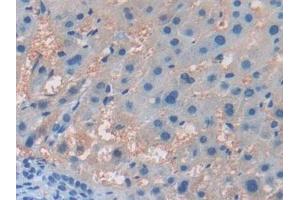 Detection of ITGb5 in Human Liver cancer Tissue using Polyclonal Antibody to Integrin Beta 5 (ITGb5) (Integrin beta 5 Antikörper  (AA 137-378))