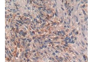 IHC-P analysis of Human Lung cancer Tissue, with DAB staining. (GHRH Antikörper  (AA 19-108))