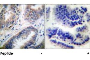 Immunohistochemical analysis of paraffin-embedded human lung carcinoma tissue using CASP9 polyclonal antibody . (Caspase 9 Antikörper)
