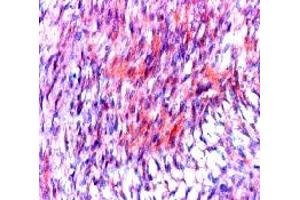 Formalin fixed paraffin embedded human stromal tumor stained with CD117 / c-kit antibody. (KIT Antikörper  (C-Term))