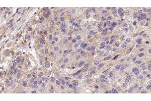ABIN6278573 at 1/100 staining Human melanoma tissue by IHC-P. (GAS6 Antikörper  (Internal Region))