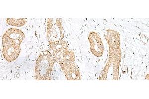 Immunohistochemistry of paraffin-embedded Human breast cancer tissue using BEX2 Polyclonal Antibody at dilution of 1:45(x200) (BEX2 Antikörper)