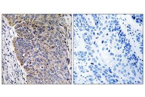 Immunohistochemistry analysis of paraffin-embedded human lung carcinoma tissue using MGST3 antibody. (MGST3 Antikörper  (N-Term))