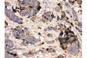 Anti- Prealbumin Picoband antibody,IHC(P) IHC(P): Human Lung Cancer Tissue (TTR Antikörper  (AA 21-147))