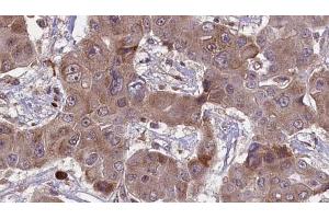 ABIN6269005 at 1/100 staining Human liver cancer tissue by IHC-P. (Metabotropic Glutamate Receptor 4 Antikörper  (C-Term))