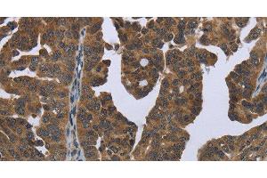 Immunohistochemistry of paraffin-embedded Human ovarian cancer tissue using GYS2 Polyclonal Antibody at dilution 1:50 (Glycogen Synthase 2 Antikörper)