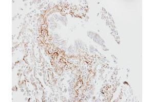 IHC-P Image Immunohistochemical analysis of paraffin-embedded human lung fibrose tissue, using SGLT1, antibody at 1:100 dilution. (SLC5A1 Antikörper  (Center))