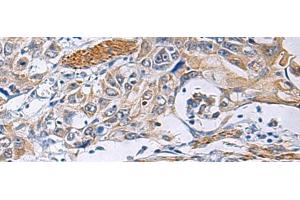 Immunohistochemistry of paraffin-embedded Human esophagus cancer tissue using FBXO45 Polyclonal Antibody at dilution of 1:40(x200)