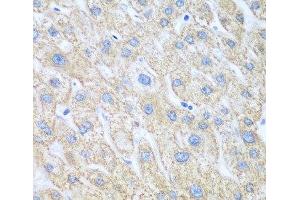 Immunohistochemistry of paraffin-embedded Human liver cancer using PTGS1 Polyclonal Antibody at dilution of 1:100 (40x lens). (PTGS1 Antikörper)
