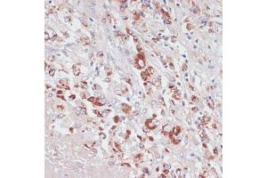 Immunohistochemistry of paraffin-embedded human liver cancer using Lysozyme (Lysozyme (LYZ)) antibody (ABIN6133802, ABIN6143409, ABIN6143412 and ABIN6217538) at dilution of 1:100 (40x lens). (LYZ Antikörper  (AA 1-100))
