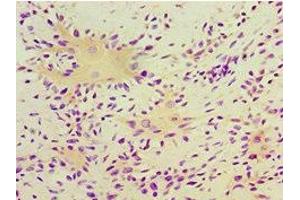 Immunohistochemistry of paraffin-embedded human breast cancer using ABIN7166413 at dilution of 1:100 (Transglutaminase 2 Antikörper  (AA 438-687))