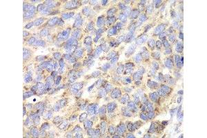Immunohistochemistry of paraffin-embedded Human esophageal cancer using ACY1 Polyclonal Antibody at dilution of 1:100 (40x lens). (Aminoacylase 1 Antikörper)
