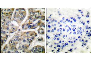Immunohistochemical analysis of paraffin-embedded human breast carcinoma tissue using Granzyme B antibody. (GZMB Antikörper)