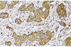Immunohistochemistry of paraffin-embedded Human liver cancer using UGDH Polyclonal Antibody at dilution of 1:100 (40x lens). (UGDH Antikörper)