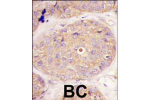 Formalin-fixed and paraffin-embedded human breast carcinoma tissue reacted with GGPS1 polyclonal antibody  , which was peroxidase-conjugated to the secondary antibody, followed by DAB staining .