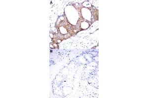 Immunohistochemical staining of human breast cancer tissue by GSK3A (phospho S21) polyclonal antibody  without blocking peptide (A) or preincubated with blocking peptide (B) under 1:50-1:100 dilution. (GSK3 alpha Antikörper  (pSer21))