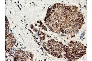 Immunohistochemical staining of paraffin-embedded Adenocarcinoma of Human breast tissue using anti-CLPP mouse monoclonal antibody. (CLPP Antikörper)