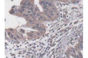 Detection of RDX in Human Liver cancer Tissue using Polyclonal Antibody to Radixin (RDX) (Radixin Antikörper  (AA 5-295))