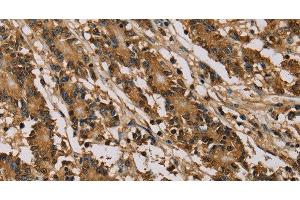 Immunohistochemistry of paraffin-embedded Human colon cancer using PSMC2 Polyclonal Antibody at dilution of 1:30 (PSMC2 Antikörper)