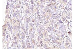 ABIN6269189 at 1/100 staining Human breast cancer tissue by IHC-P. (Filamin A Antikörper  (Internal Region))