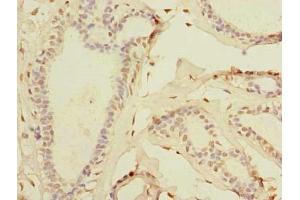 Immunohistochemistry of paraffin-embedded human breast cancer using ABIN7171935 at dilution of 1:100 (TTC33 Antikörper  (AA 1-262))