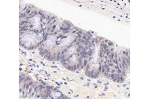 Immunohistochemistry analysis of paraffin-embedded human colon cancer using PARN (ABIN7075117) at dilution of 1: 1800 (PARN Antikörper)