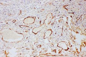Anti- Adiponectin antibody, IHC(P) IHC(P): Human Lung Cancer Tissue