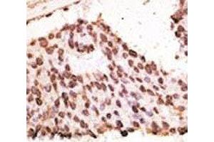IHC analysis of FFPE human breast carcinoma tissue stained with the MMP7 antibody (MMP7 Antikörper  (AA 117-146))